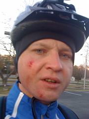 Bike accident Dec 2008